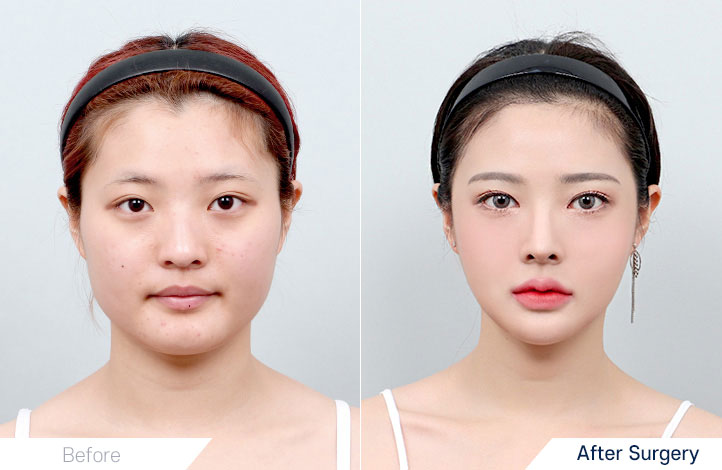 Facial contour 20前后照片