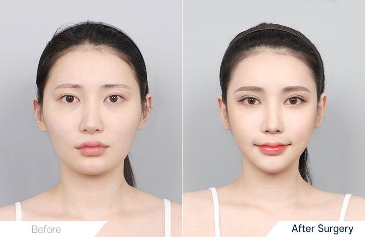 Facial contour 21前后照片