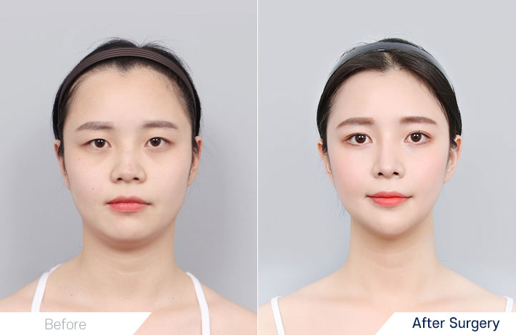 Facial contour 22前后照片