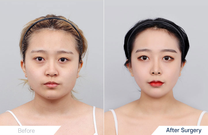 Facial contour 24前后照片