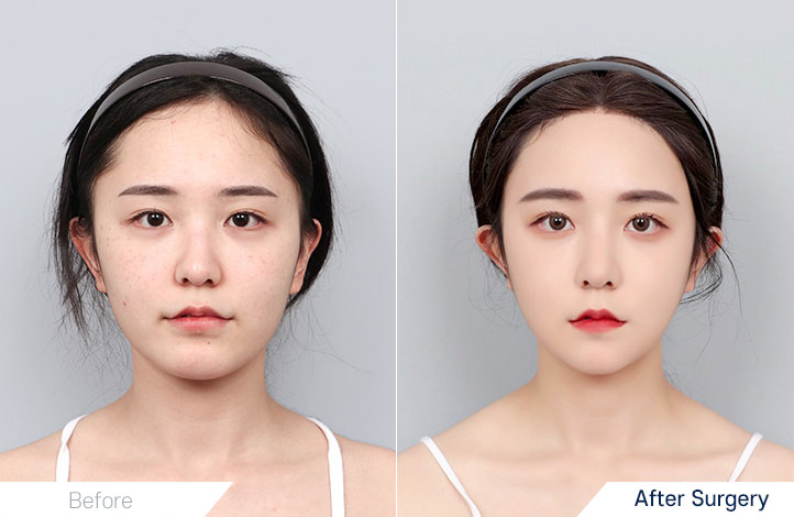 Facial contour 25前后照片