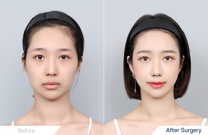 Facial contour 26前后照片
