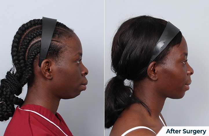 Facial contour 27前后照片