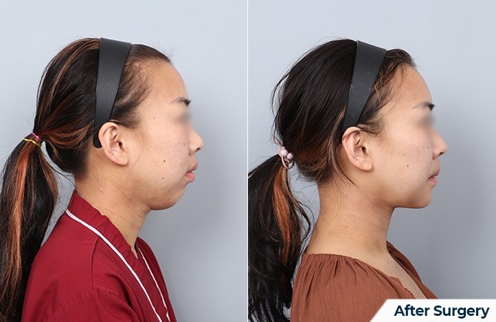 Facial contour 28前后照片