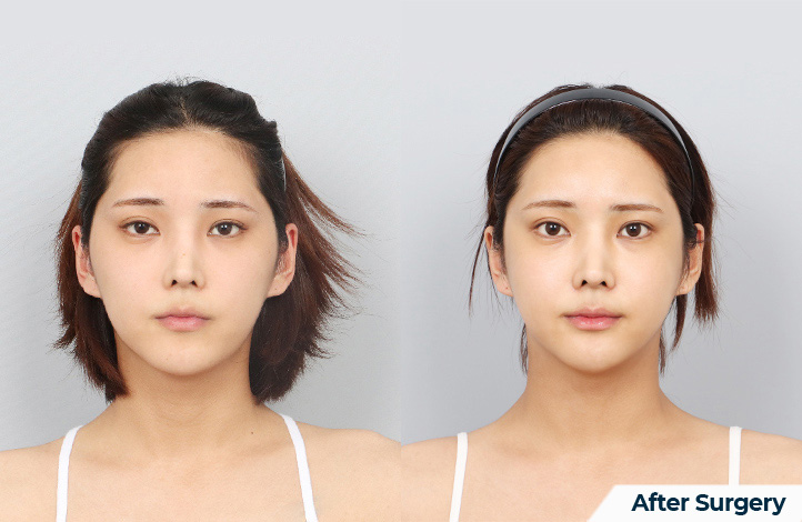 Facial contour 29前后照片