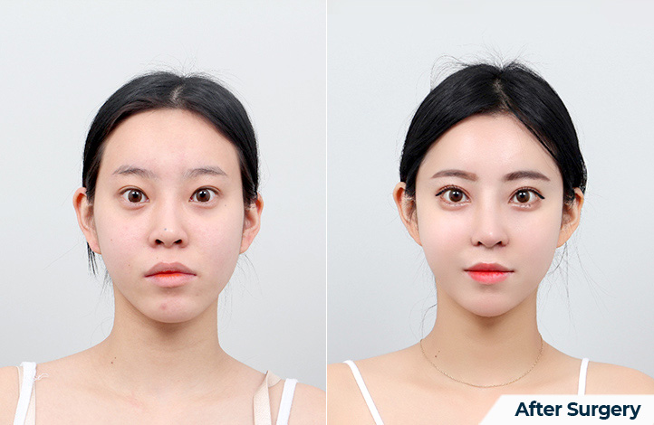 Facial contour 30前后照片