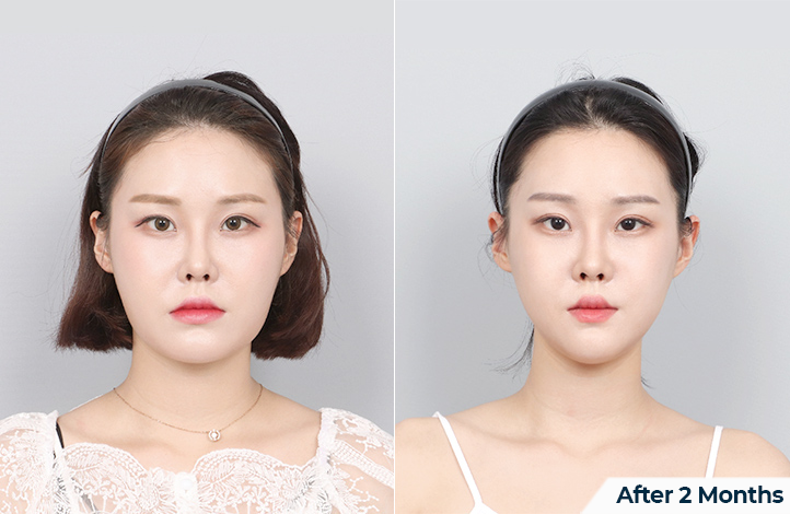 Facial contour 31前后照片