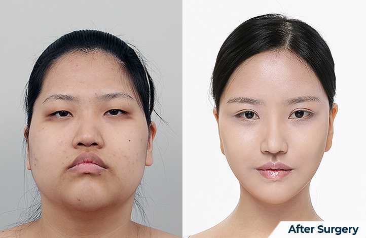 Facial contour 32前后照片