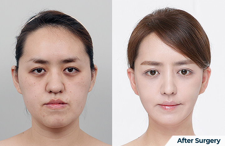 Facial contour 33前后照片