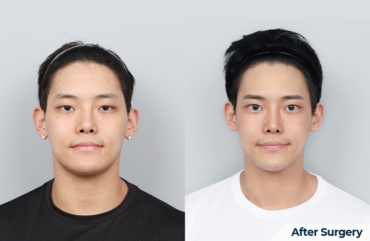 Facial contour 35前后照片