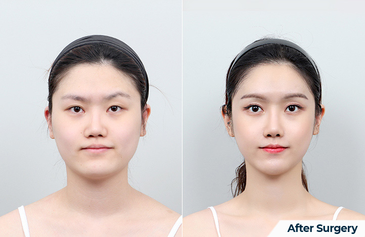 Facial contour 36前后照片