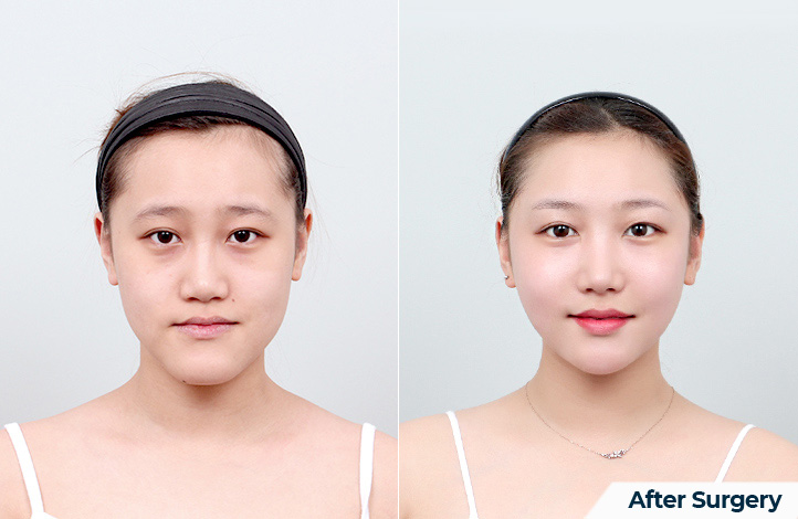 Facial contour 37前后照片
