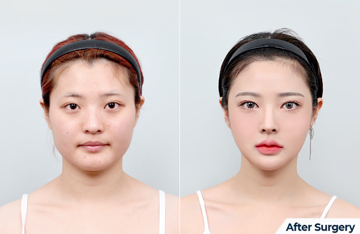 Facial contour 38前后照片