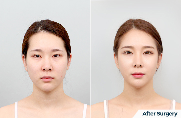 Facial contour 39前后照片