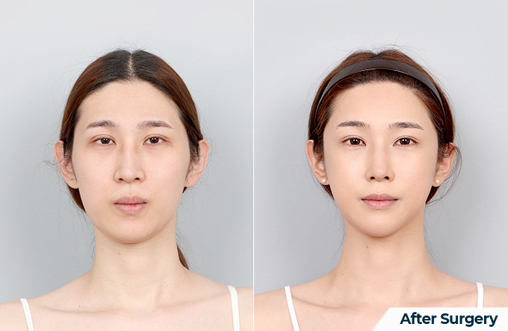 Facial contour 41前后照片