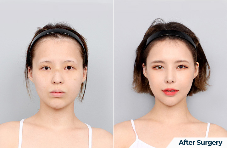 Facial contour 42前后照片