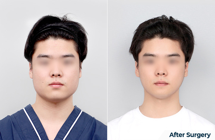 Facial contour 43前后照片