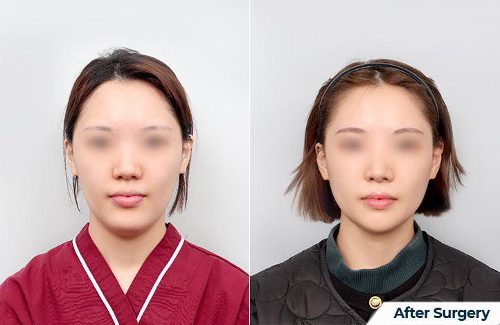 Facial contour 44前后照片
