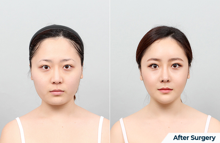 Facial contour 45前后照片