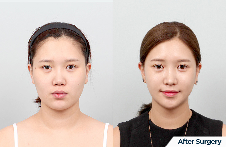 Facial contour 46前后照片