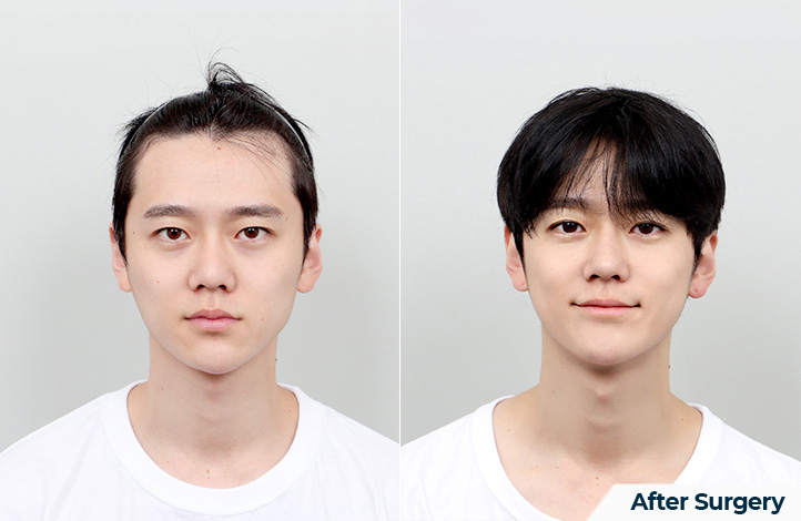 Facial contour 47前后照片