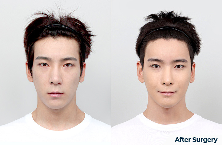 Facial contour 49前后照片