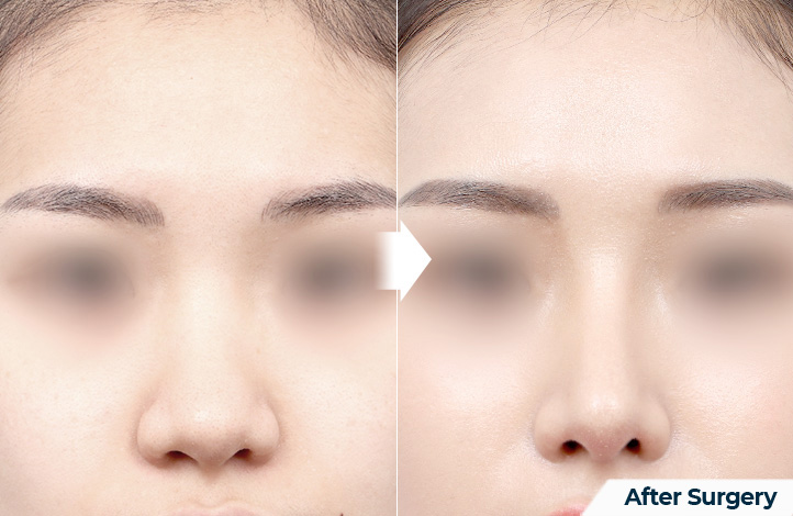 Facial contour 50前后照片