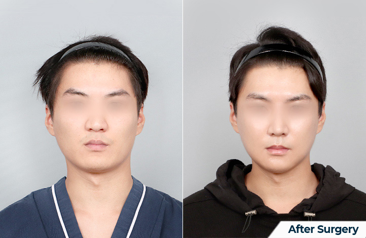 Facial contour 51前后照片