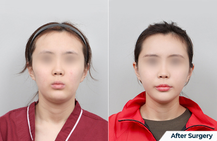 Facial contour 52前后照片