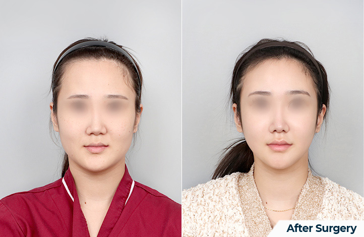 Facial contour 53前后照片