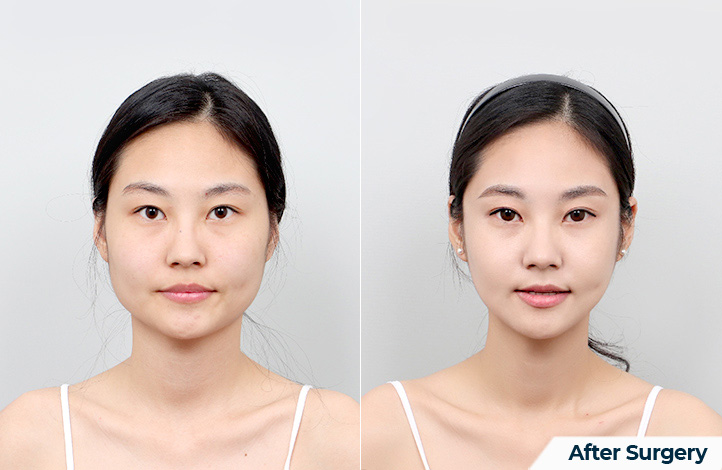 Facial contour 54前后照片