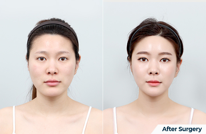 Facial contour 55前后照片