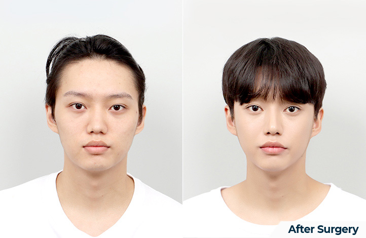 Facial contour 56前后照片