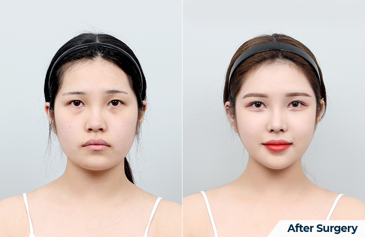 Facial contour 58前后照片