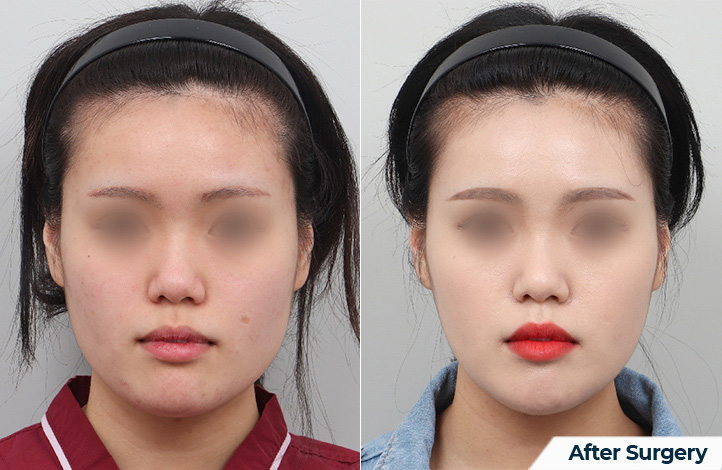 Facial contour 59前后照片