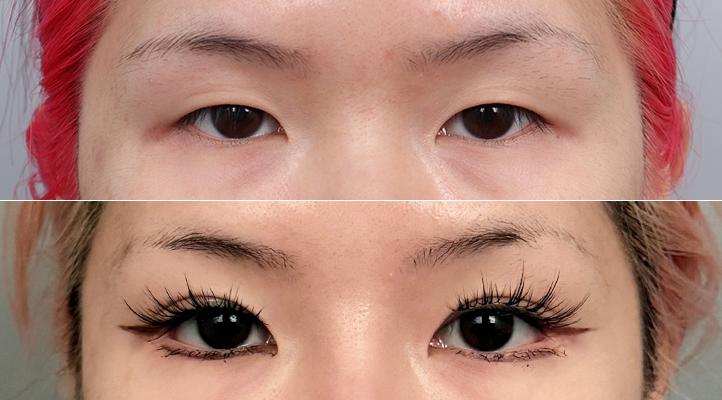 DA 双眼皮手术前后照片