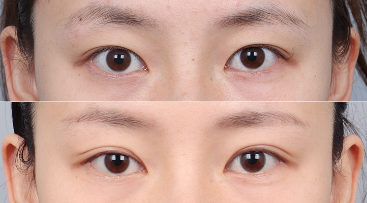DA 双眼皮手术前后照片