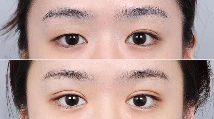 DA 双眼皮手术前后照片