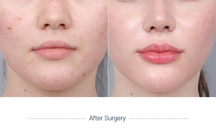 嘴角手术前后照片