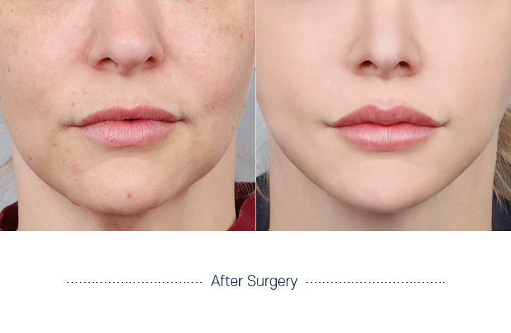 嘴角手术前后照片