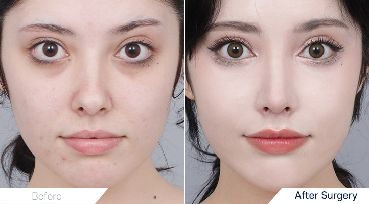 鼻整形前后照片