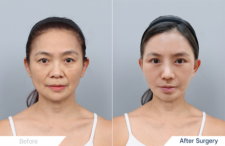 鼻整形, 全脸提升, 颈部提升, 上眼睑, 下眼睑, Accu提升前后照片