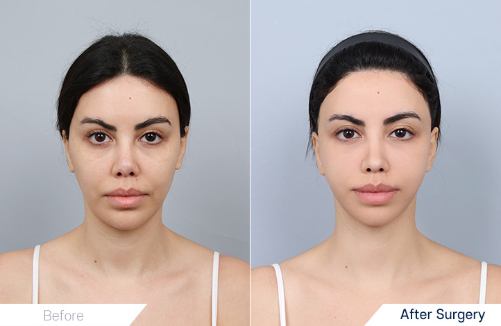 全脸提升, 颈部拉皮术, Accu提升前后照片