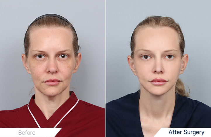 全脸提升, 嘴角手术, 吸脂, 隆胸前后照片