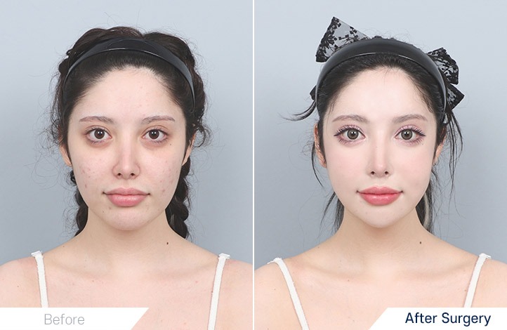 轮廓三件套前后照片