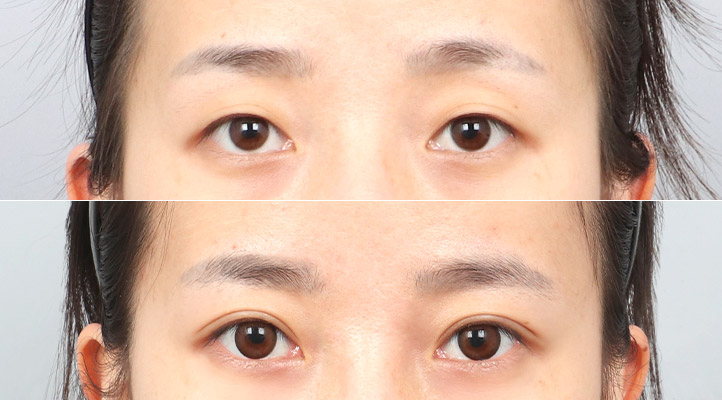 DA 双眼皮手术前后照片