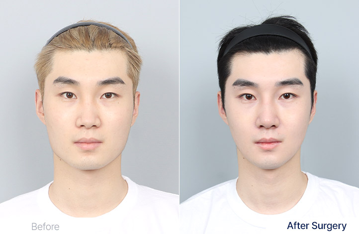 轮廓三件套前后照片