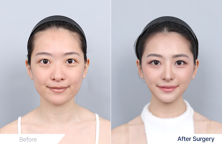 鼻整形 , V-line 下颌角手术前后照片